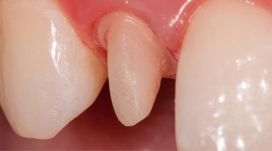 بعد تركيبات-اسنان